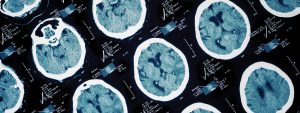 brain injury scan image