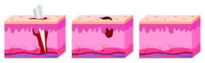 graphic of penetrating trauma injury