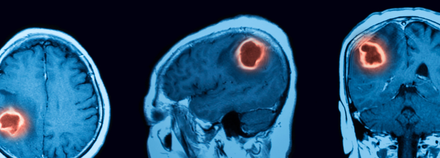 Brain Injury